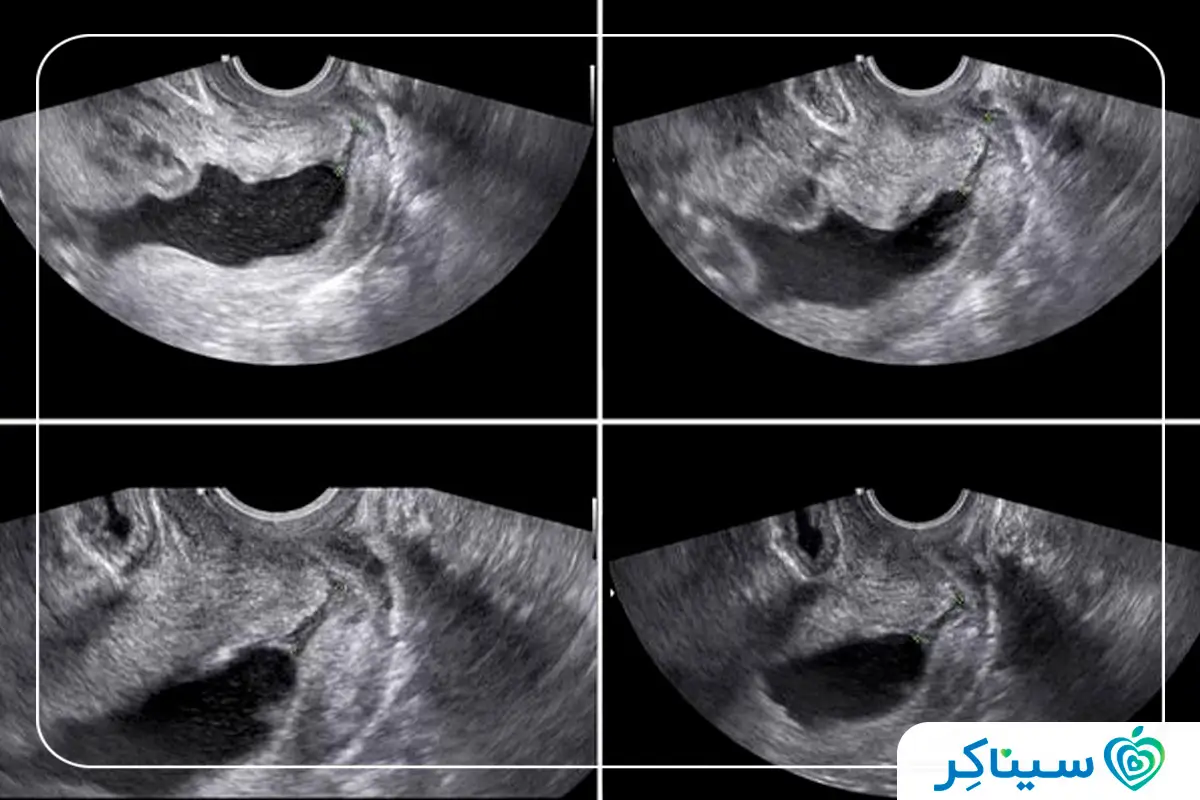 تصویر سونوگرافی جنین دختر در ۱۸ هفتگی