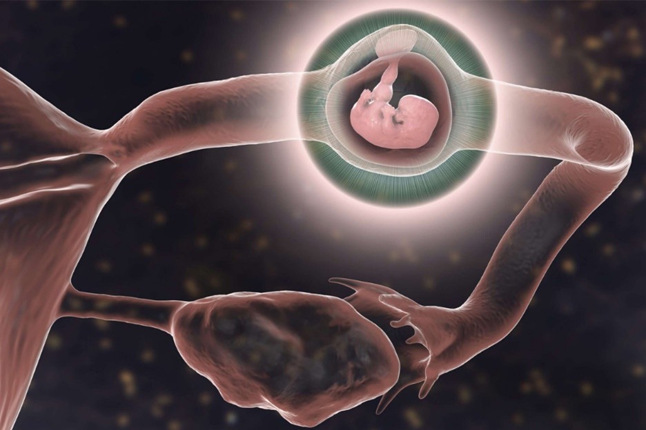 عکس بارداری خارج از رحم