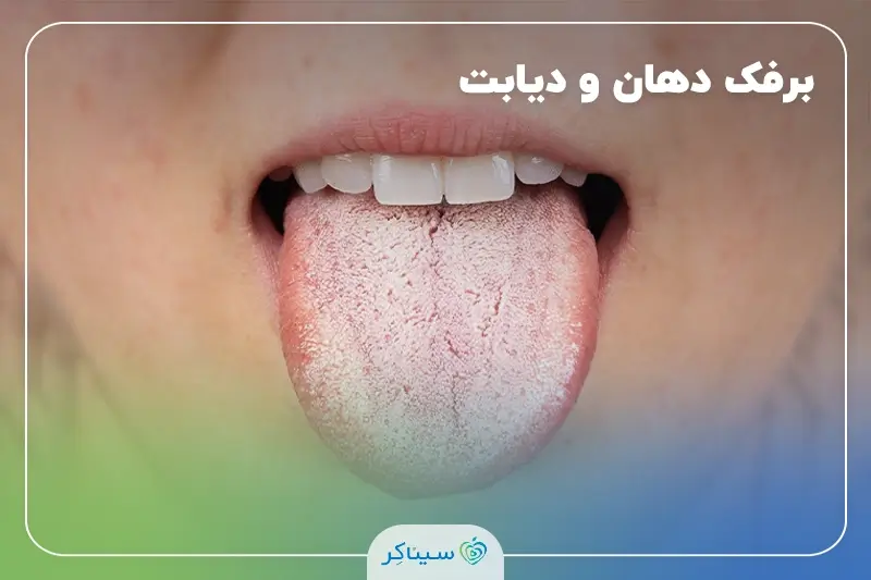 رابطه دیابت و برفک دهان