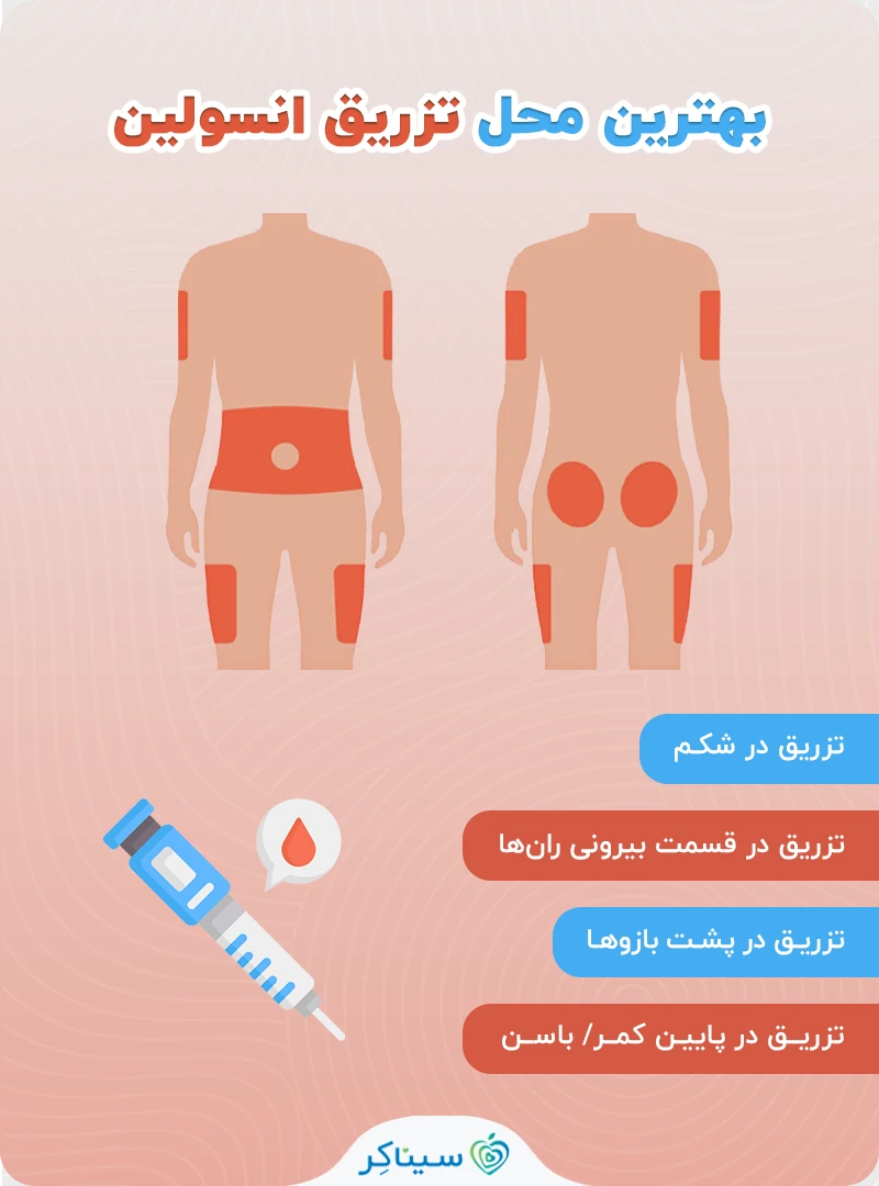 مناسب ترین محل تزریق انسولین 