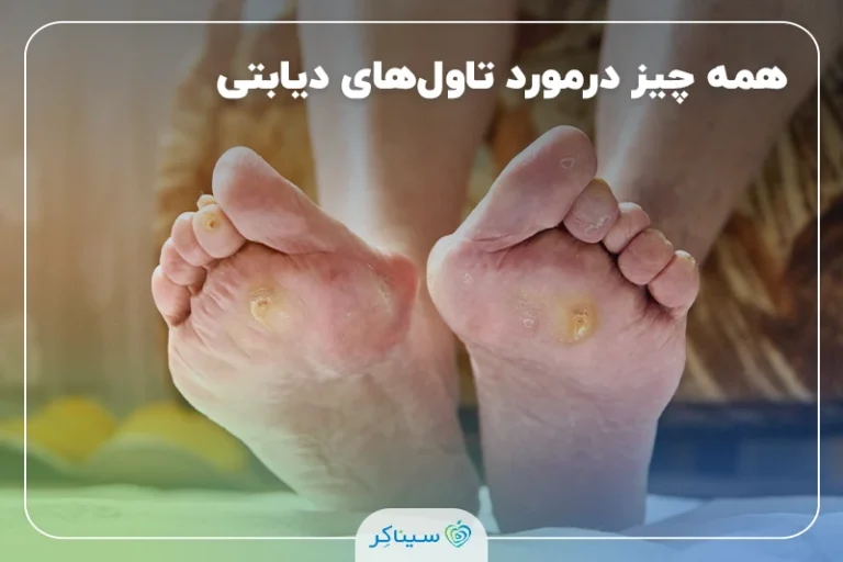 تاول‌های دیابتی؛ انواع، علل و روش‌های کامل درمان و پیشگیری