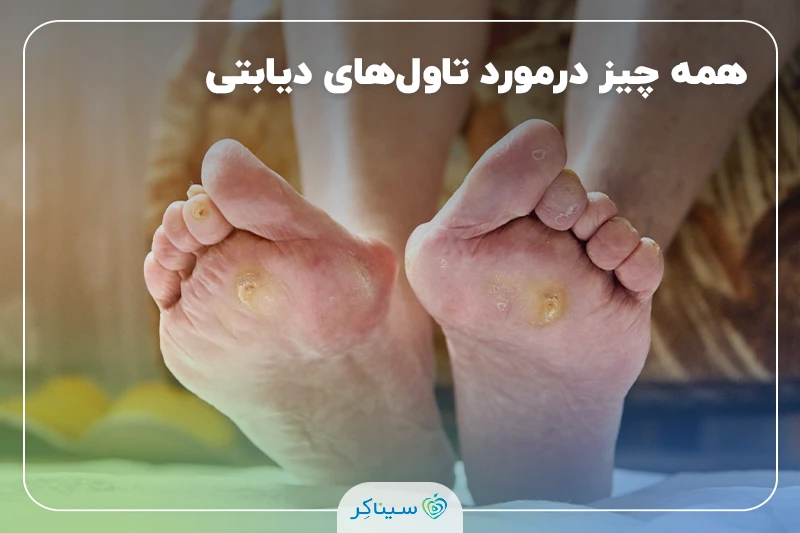تاول‌های دیابتی؛ انواع، علل و روش‌های کامل درمان و پیشگیری