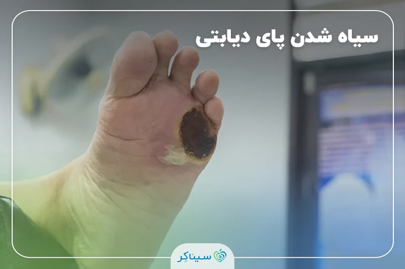 سیاه شدن پای دیابتی