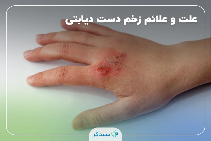 زخم دست دیابتی چیست؟ علت، انواع، علائم و درمان